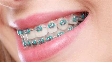 metal braces for gums